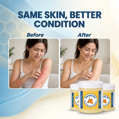 HoneyJar - Steroid Free Balm for Eczema & Psoriasis